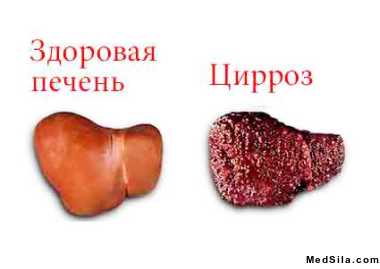 нормальная печень и печень, пораженная циррозом